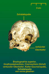 Verkürzter Oberkiefer mit Kiefer-Gaumenspalte